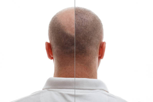 greffe de cheveux homme à Paris 