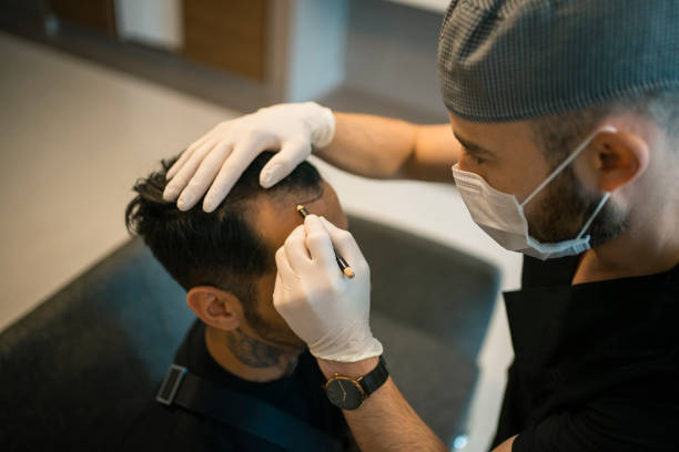 greffe de cheveux homme à Paris