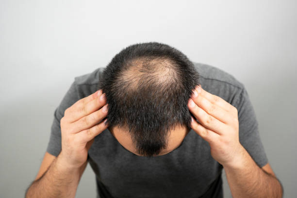 greffe de cheveux à Paris