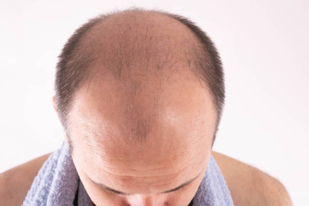 greffe de cheveux après 1 mois