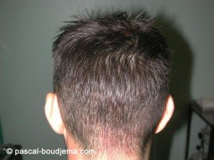 cicatrice invisible greffe cheveux