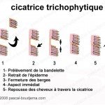 cicatrice trichophytique