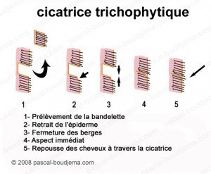cicatrice-trichophytique
