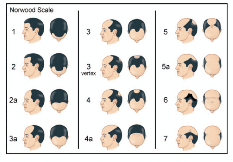 Comprendre la calvitie Les Greffes de Cheveux — free download