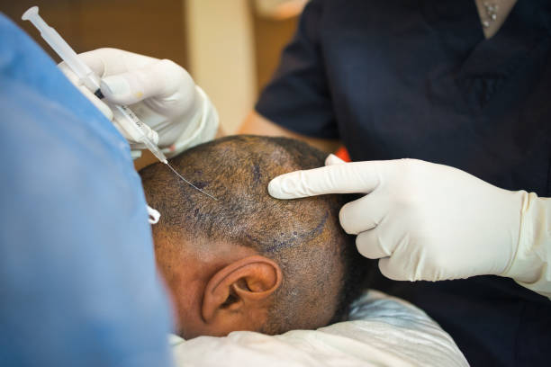 greffe de cheveux homme à Paris