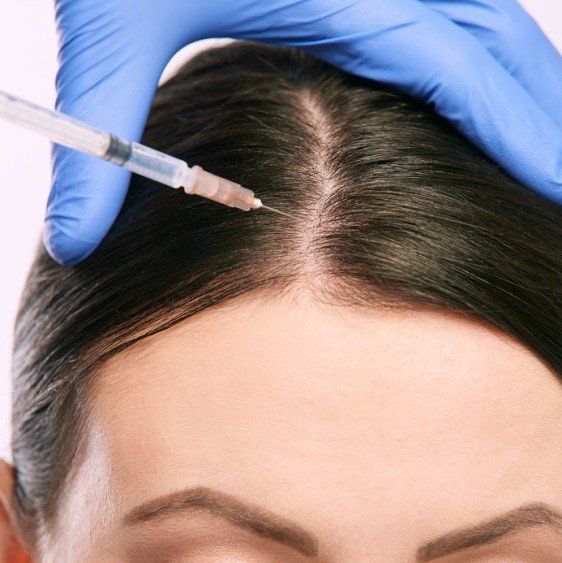 injections de prp greffe de cheveux femme