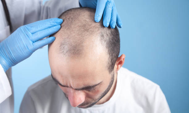 greffe de cheveux à Paris