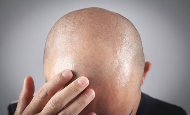 greffe de cheveux après 1 mois 