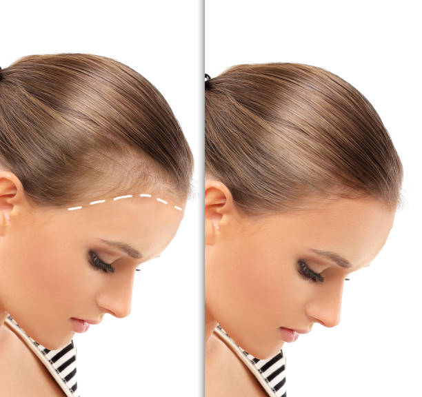 Greffe de Cheveux Naturelle pour Femmes à Paris