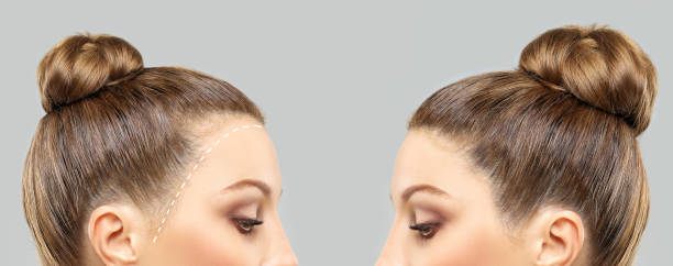 Greffe de Cheveux Naturelle pour Femmes à Paris