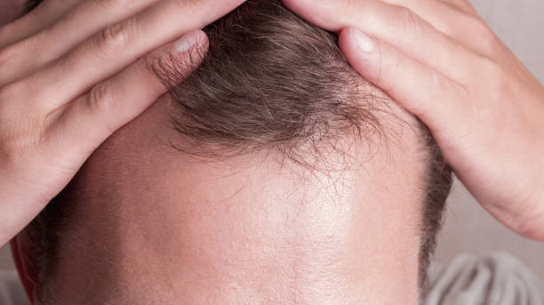 greffe de cheveux à Paris