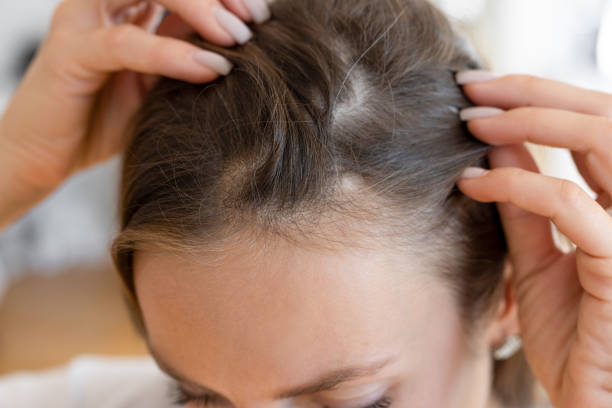 Greffe de Cheveux Naturelle pour Femmes à Paris