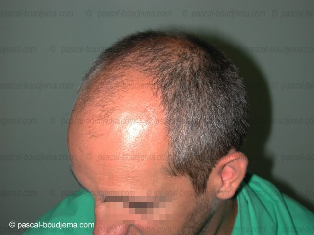 Greffe de cheveux après 1 mois