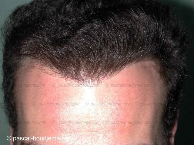 Résultats Greffe de cheveux Avant / Après - Dr Boudjema
