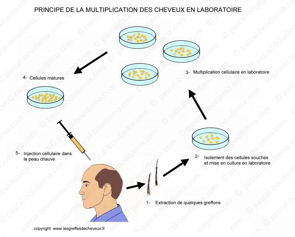 schéma clonage capillaire pour calvitie