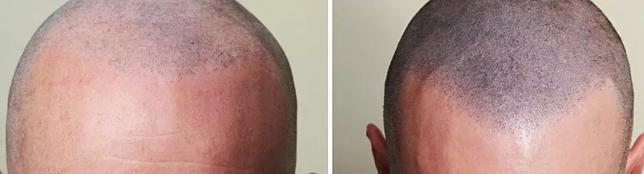 micropigmentation cuir chevelu devant