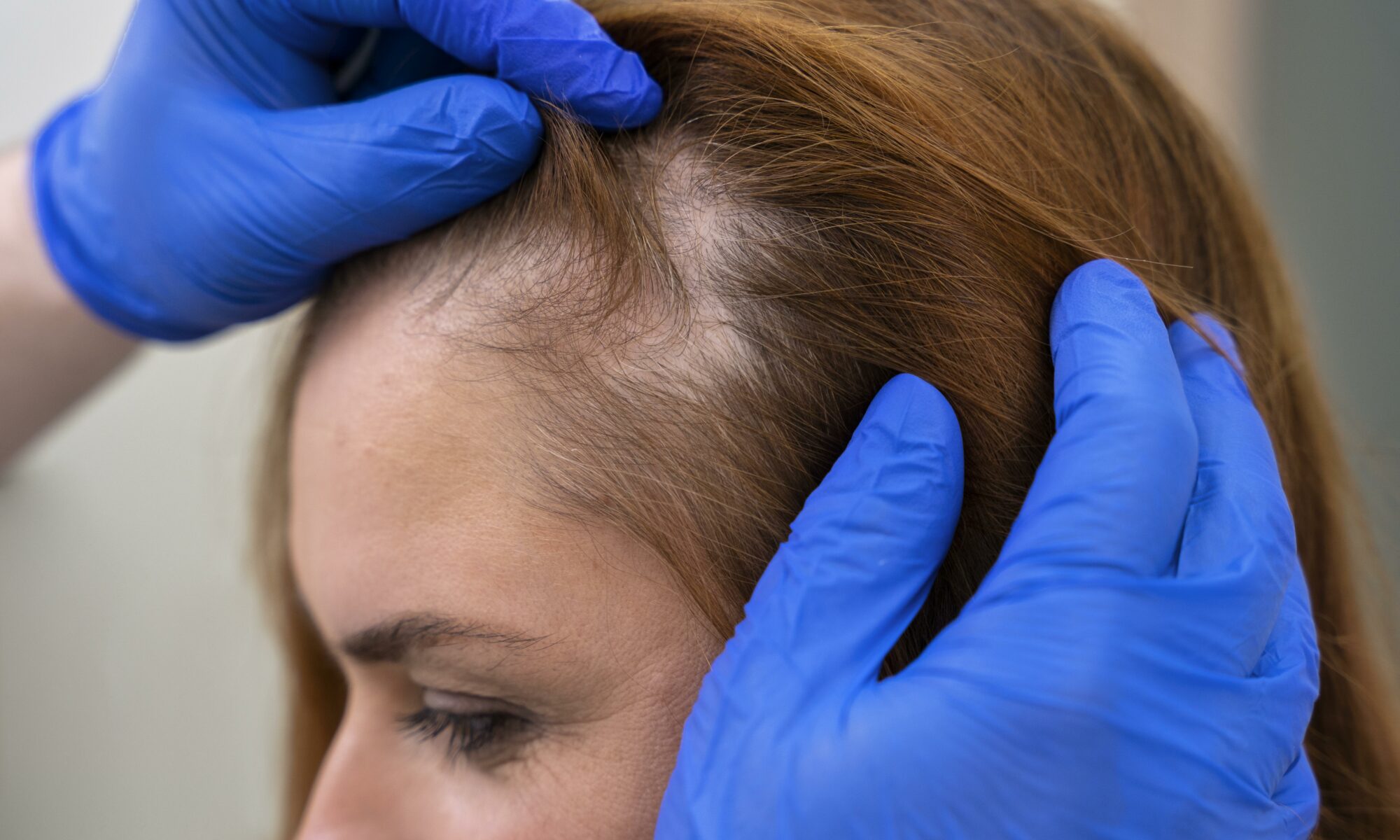 greffe de cheveux après 1 mois
