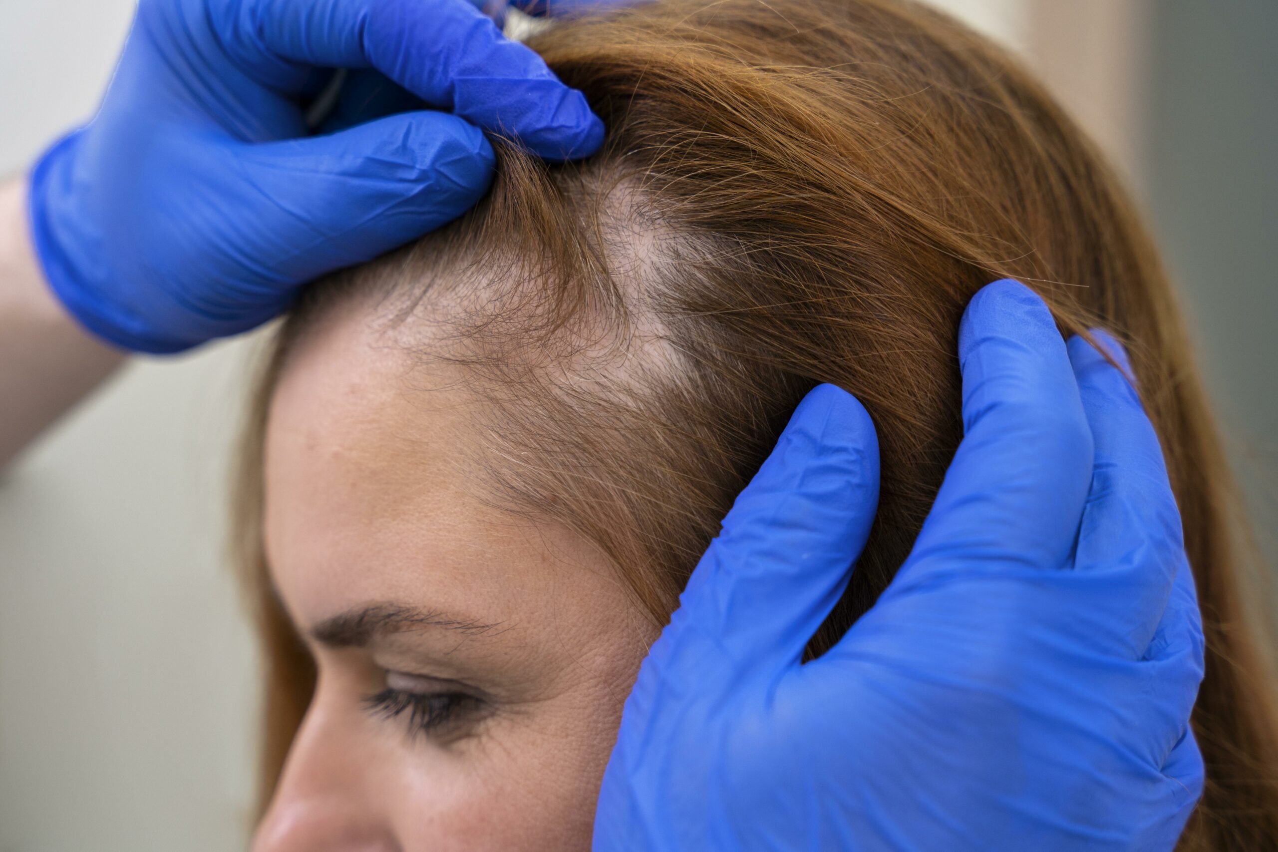 greffe de cheveux après 1 mois
